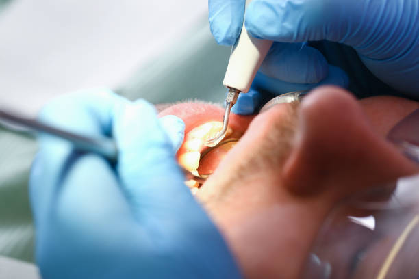 Best Emergency Wisdom Tooth Extraction in Carlyss, LA